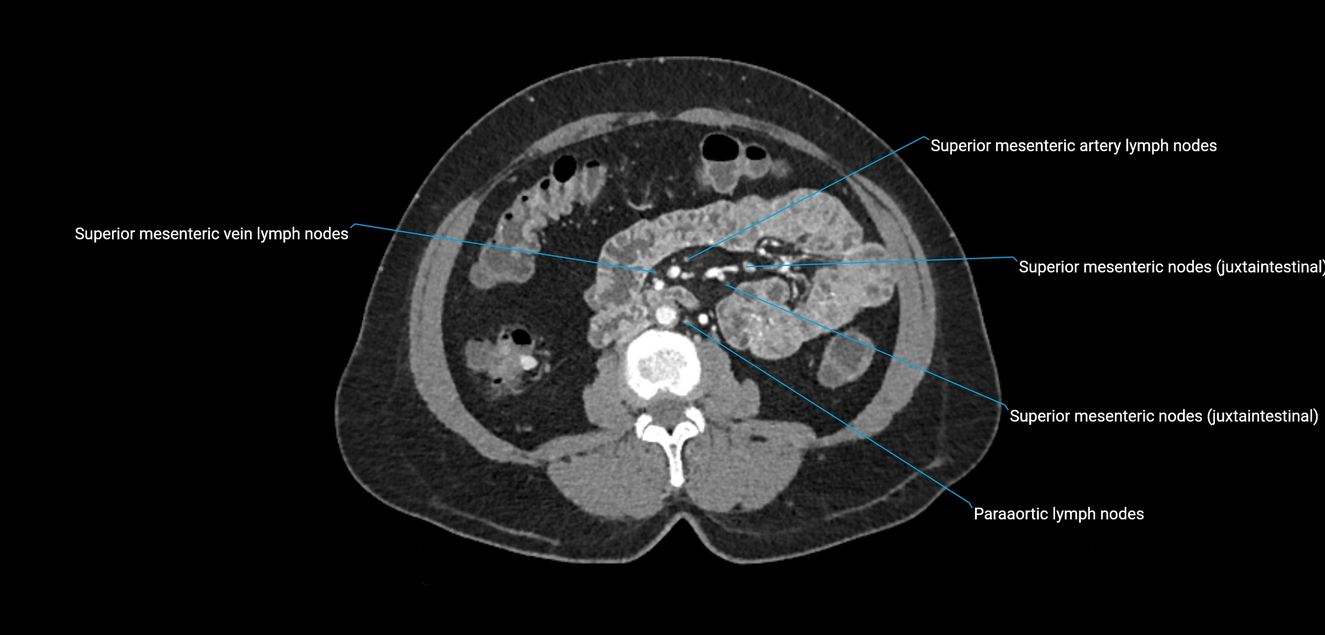 CT ct abdominal lymph nodes  axial cross sectional anatomy  enchanced radiology image -img-00002-00223.webp